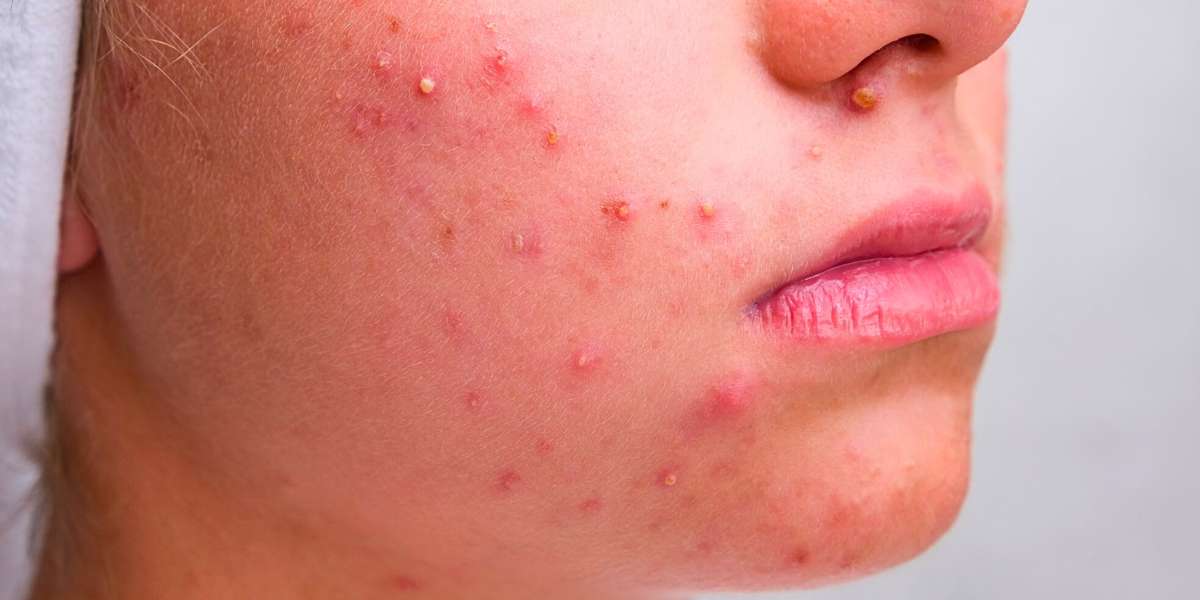 Acne