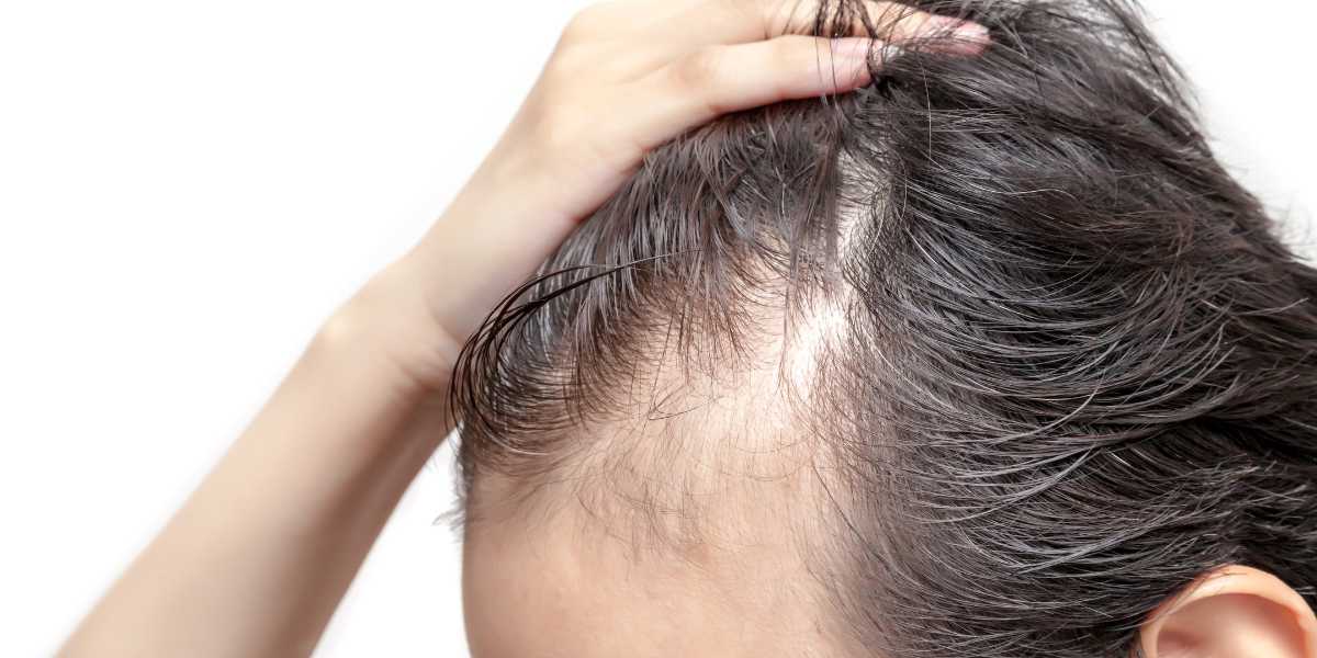 Alopecias (Queda de Cabelos)