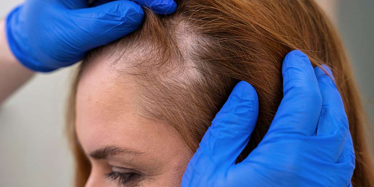 Alopecias (Queda de Cabelos)