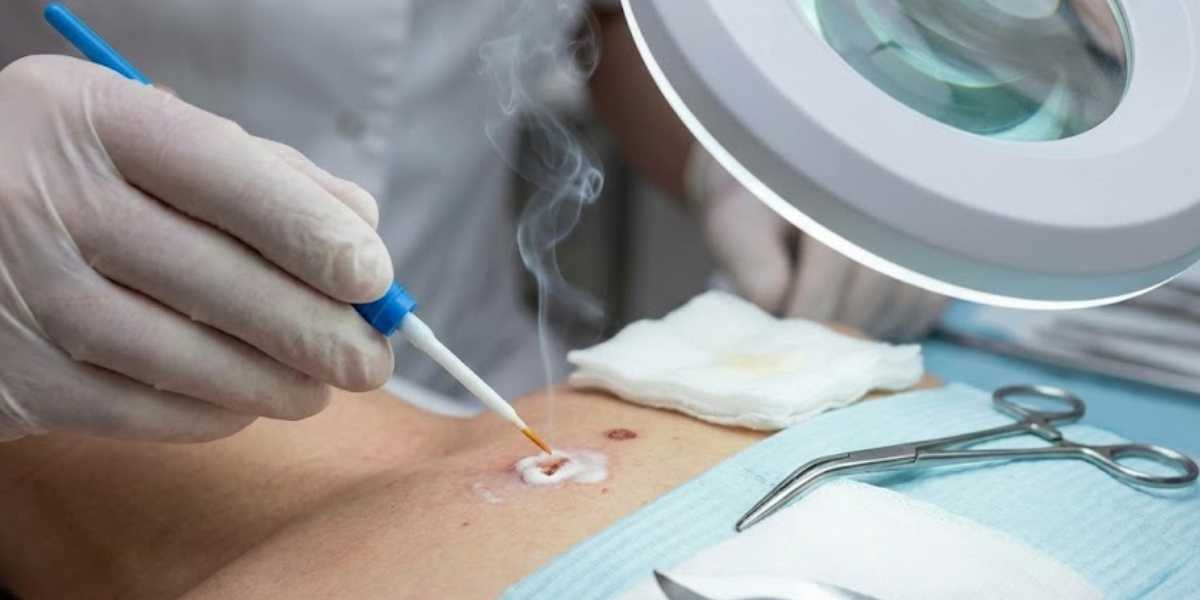 Cauterização Química