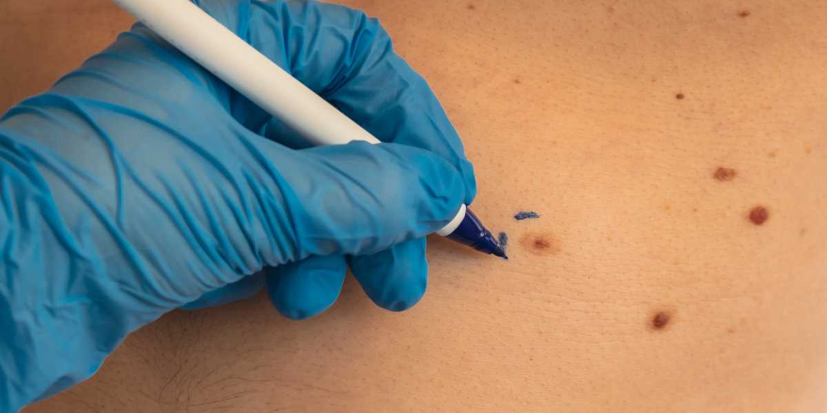 Cirurgias de Câncer de Pele