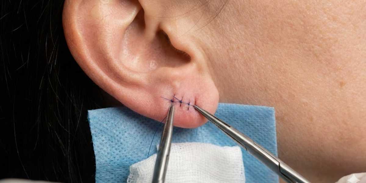 Correção de Lóbulo de Orelha