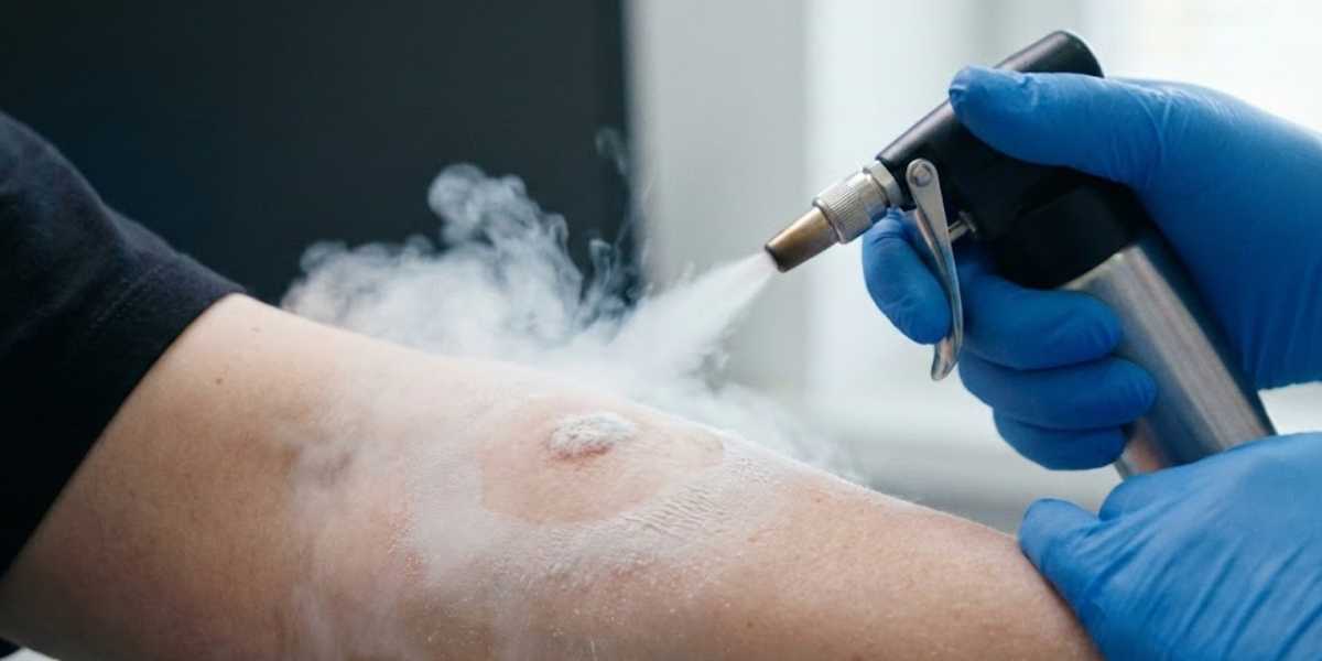 Crioterapia e Criocirurgia