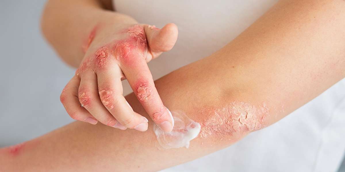 Dermatites e Eczemas