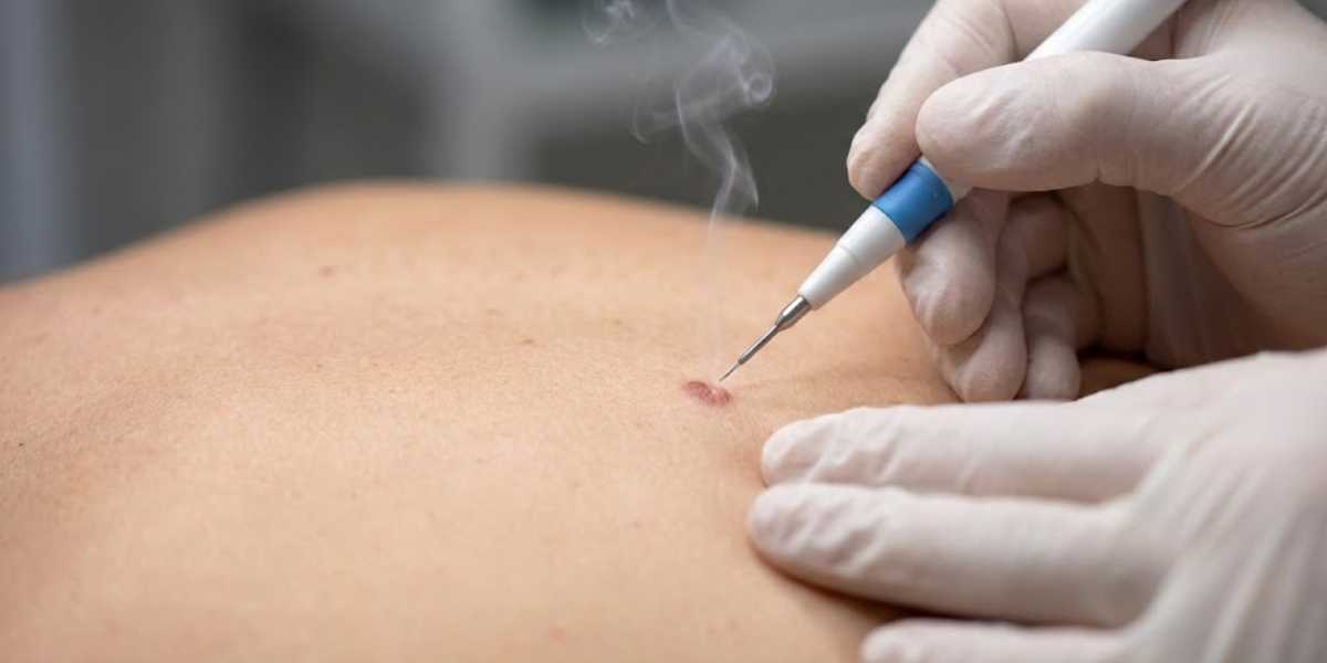 Eletrocauterização de Lesões