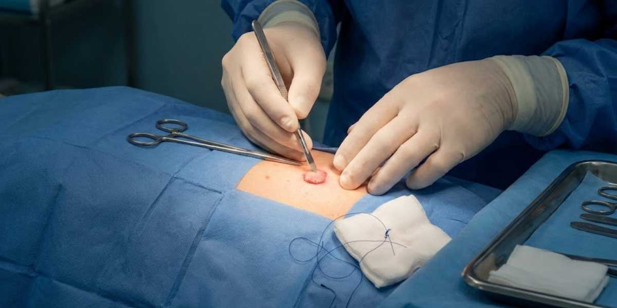 Excisões Cirúrgicas de Lesões Benignas