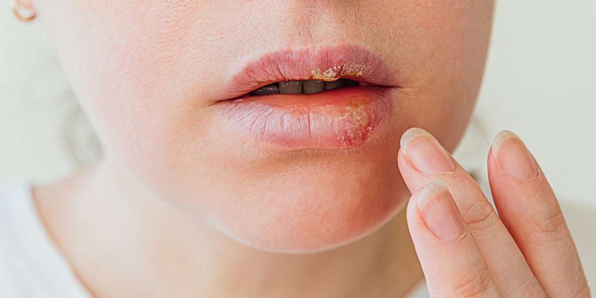Herpes