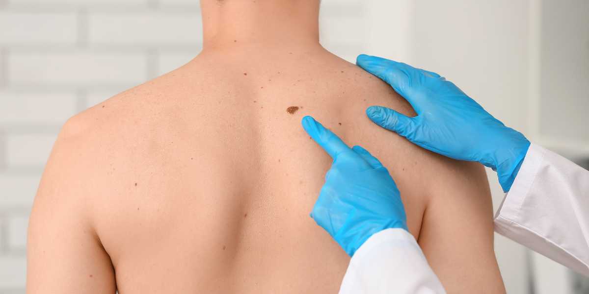 Mapeamento Corporal de Nevos