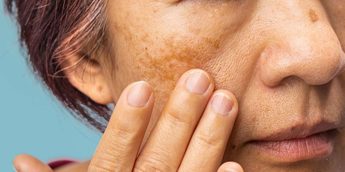 Melasma