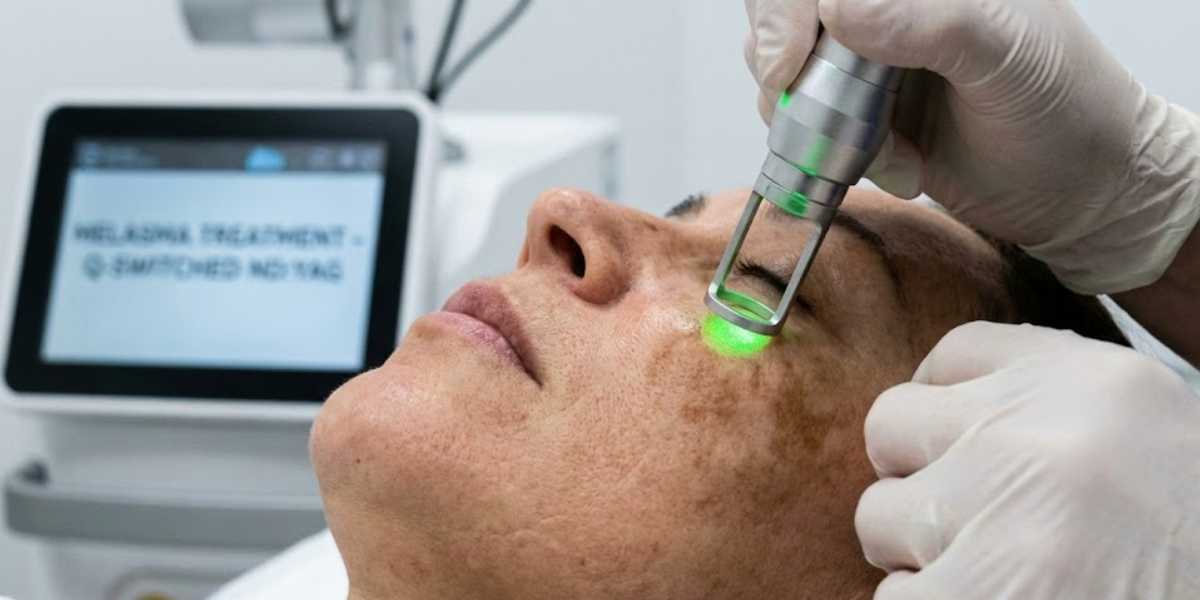 Tratamento de Melasma