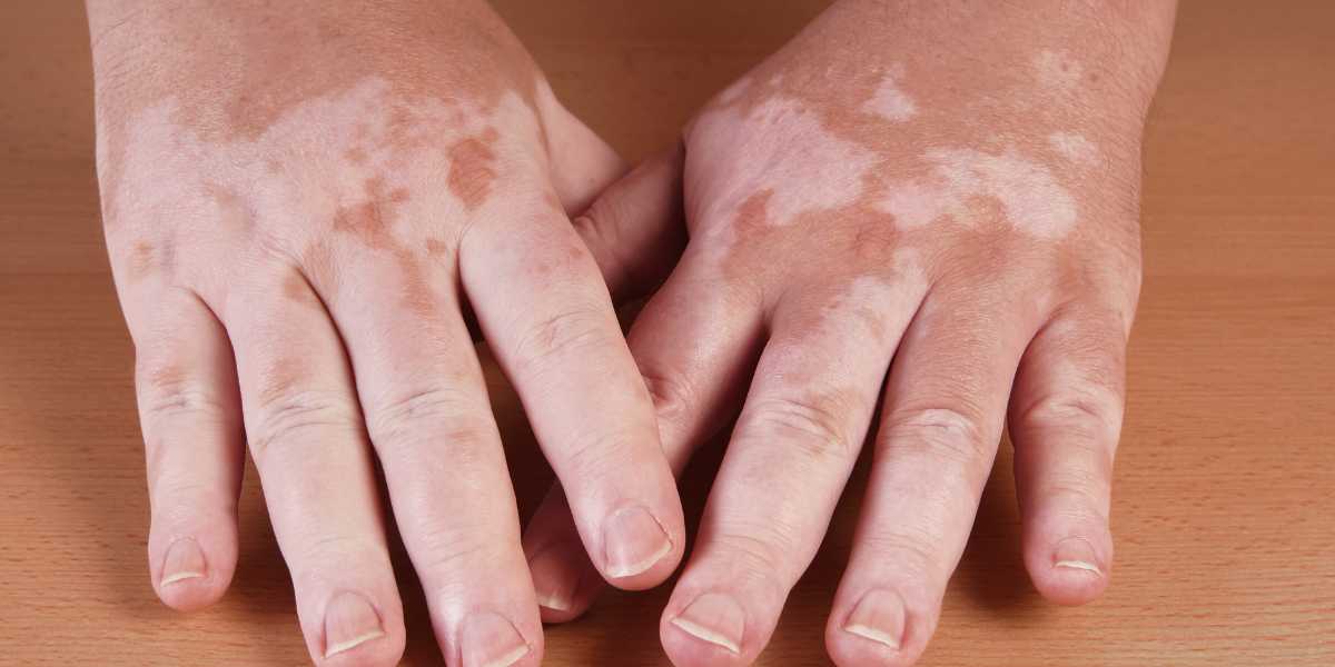 Vitiligo