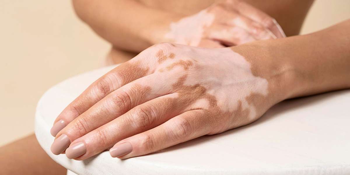 Vitiligo