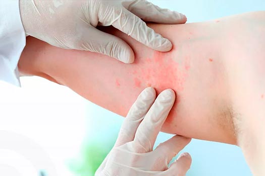 Dermatites e Eczemas