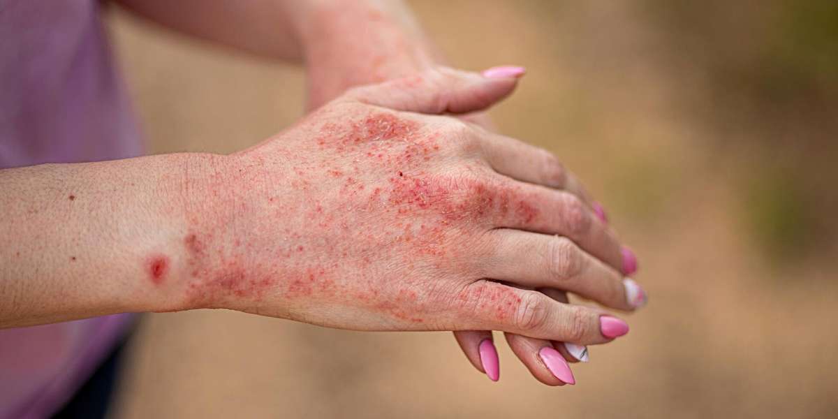 Infecções Bacterianas de Pele