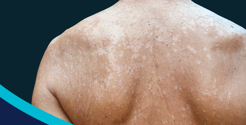 Aproveite o verão! Mas sem micoses!