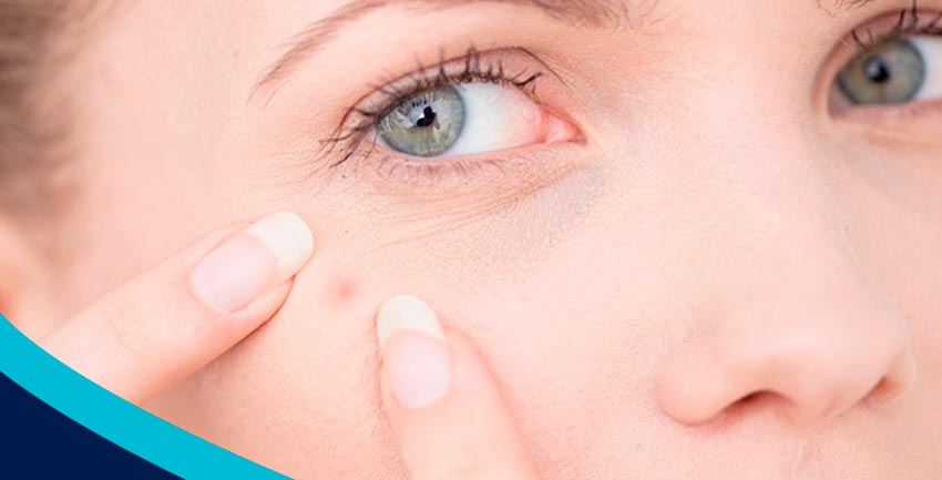 Acne: que vontade de mexer!