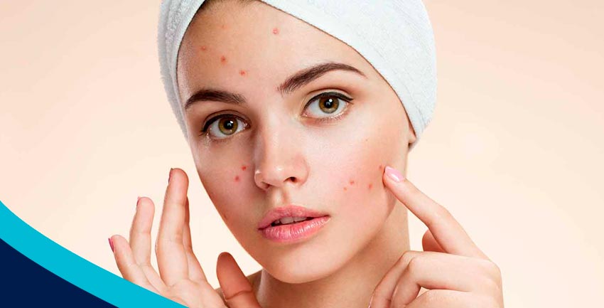 Acne – Alimentos que devem ser evitados