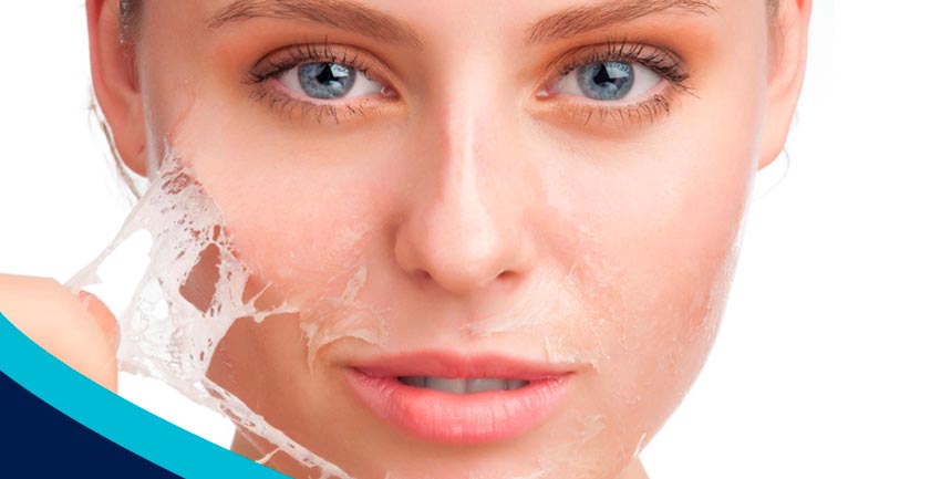 Peeling Químico