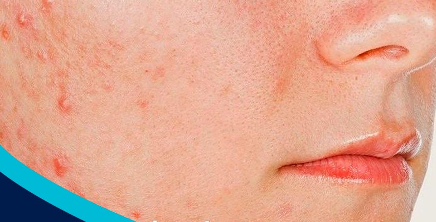 Entenda mais sobre a acne na mulher