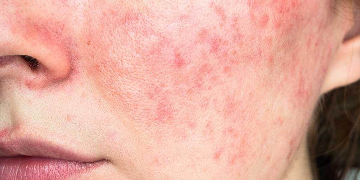 Rosácea