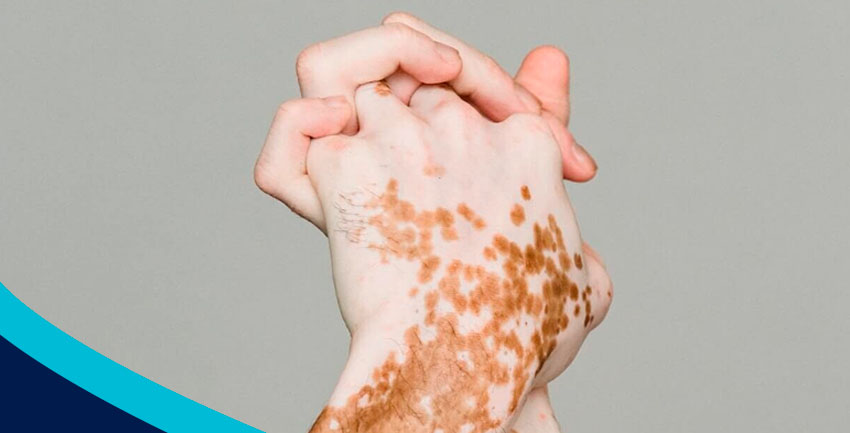 O que é vitiligo?