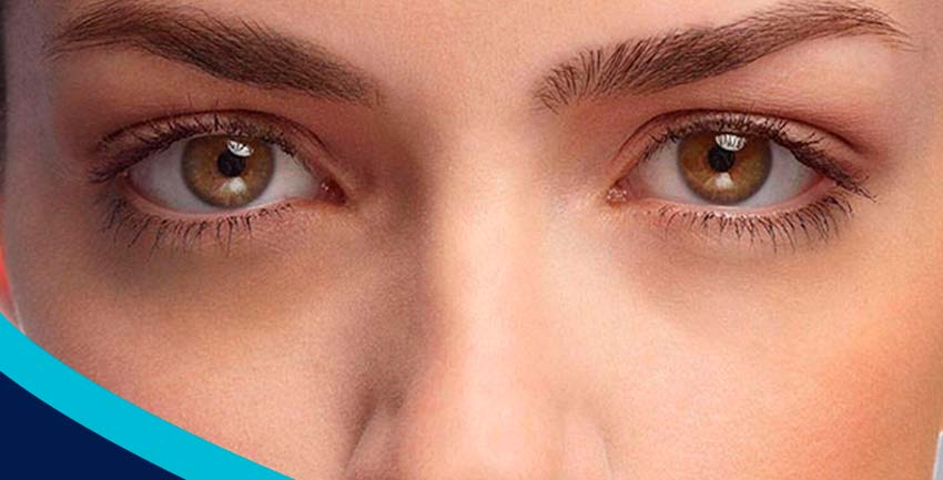 Olheiras, qual o seu tipo?