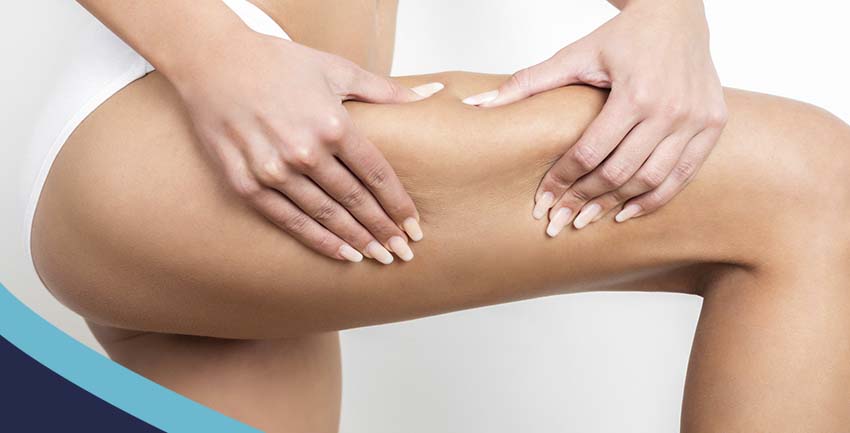 Celulite: O que é? Como evitar e como tratar?