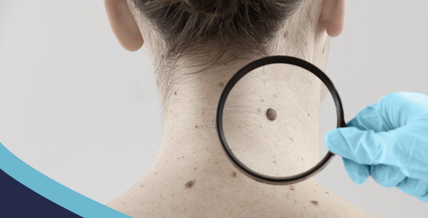 Mitos X Verdades sobre câncer de pele