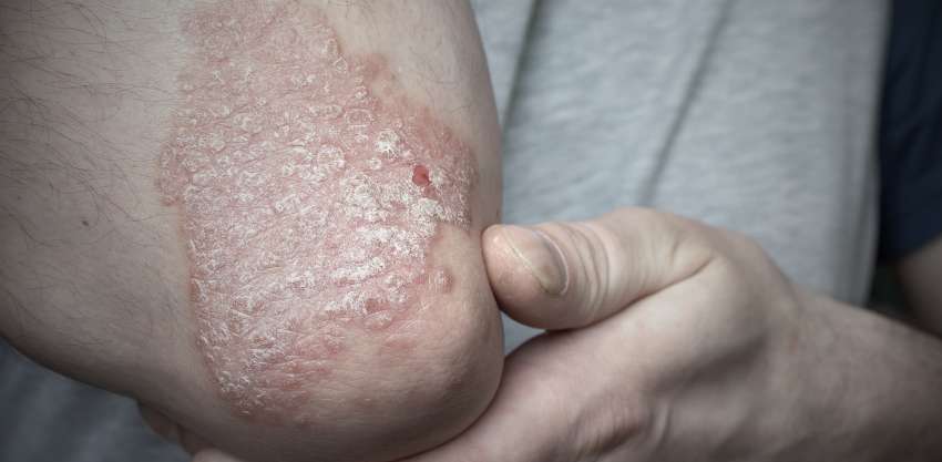 Psoríase: Sintomas, Gatilhos e Tratamentos para a Pele