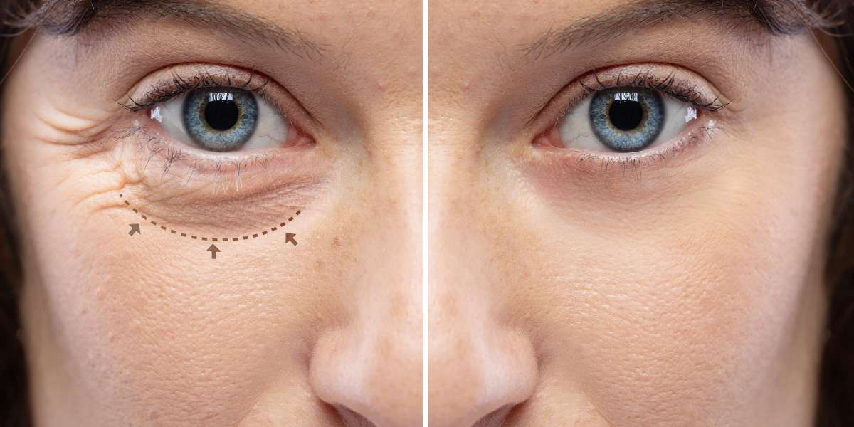 Blefaroplastia: Redescubra o Poder do Seu Olhar