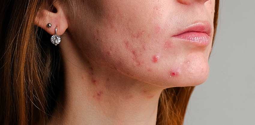 Acne na Vida Adulta: É Normal Ter Espinhas Depois dos 25?