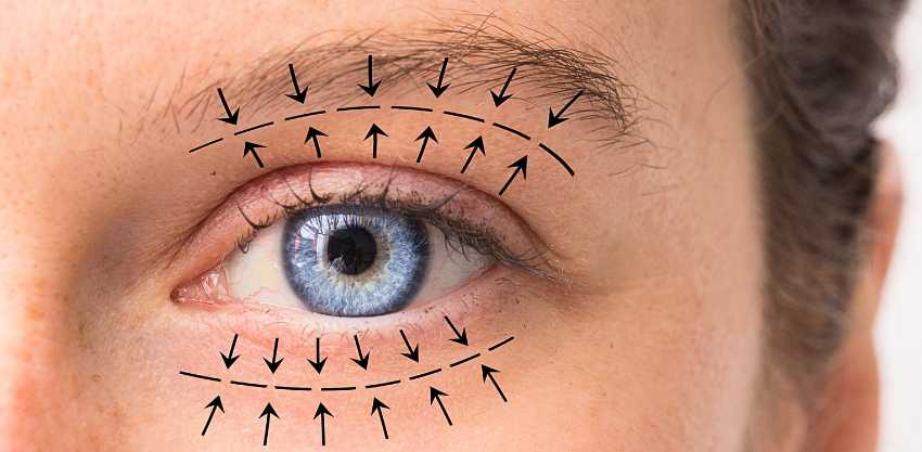 Blefaroplastia: o que é, para quem é indicada e quais os benefícios