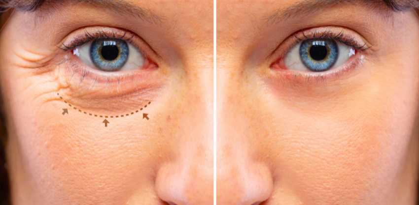 Blefaroplastia: Redescubra o Poder do Seu Olhar