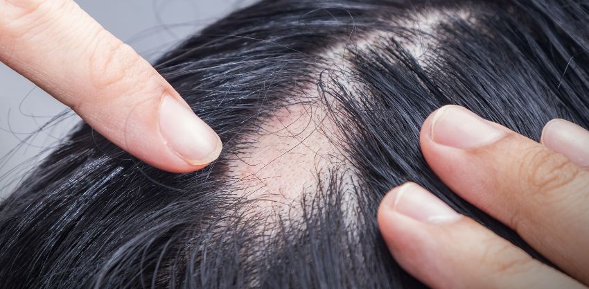 Alopecia Areata: O que é, sintomas e a importância do dermatologista