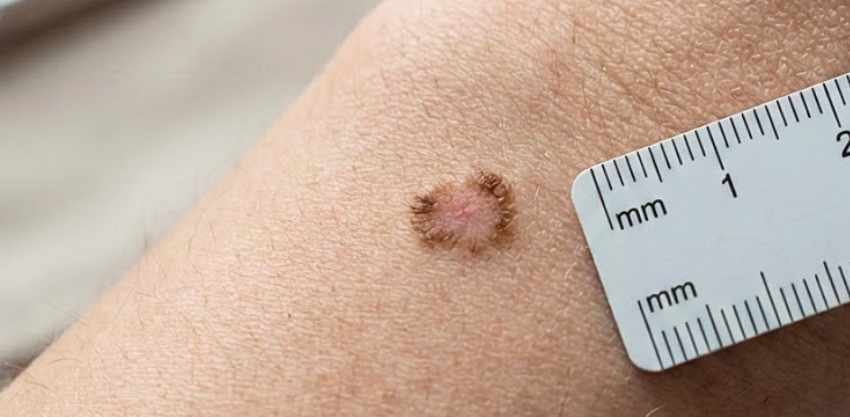Nem toda pinta é inofensiva: entenda os sinais do melanoma e proteja sua pele